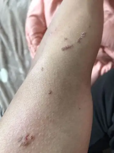 手臂上有褐色的凸起,求大神指点