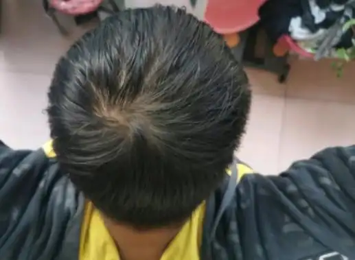 23岁小伙头顶严重脱发,担心变秃顶,不知道看中医还是西医好