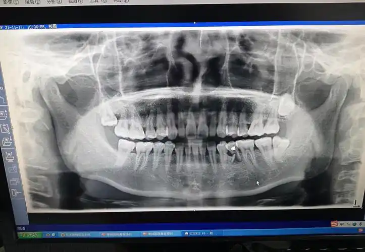 看看我拍的片牙根断了