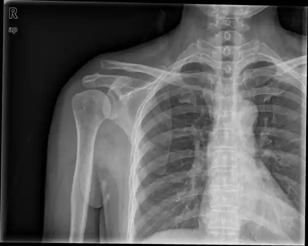 锁骨骨折及肩锁脱位的术后康复_锁骨骨折_治疗方式_康复锻炼 - 好大夫