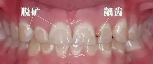 牙齿上有白斑怎么回事啊牙齿脱矿了解一下
