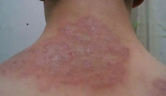 真菌引起皮肤病,快速治理的小窍门