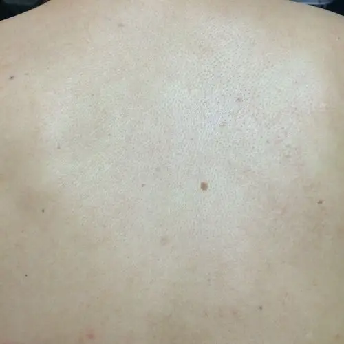 人老了后背都会长这种东西吗,我爸爸现在开始长这种