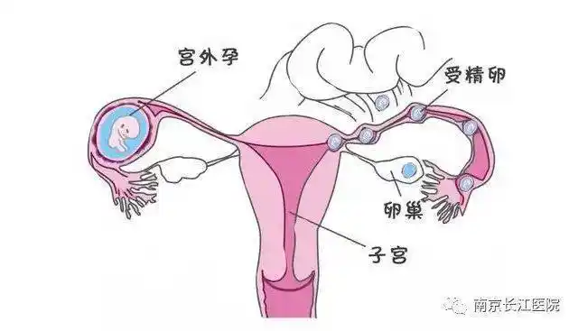 输卵管粘连有轻有重,分为三度:Ⅰ度为输卵管峡部粘连;Ⅱ度为输卵管与