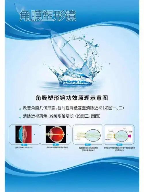 ok镜也叫角膜塑形镜