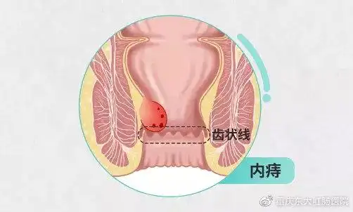 内痔肉球怎么收回去呢