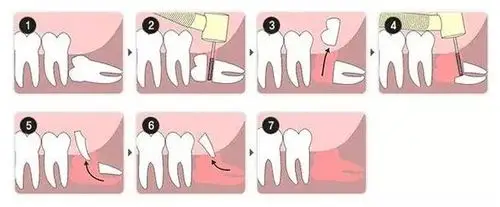 智齿拔牙过程示意图