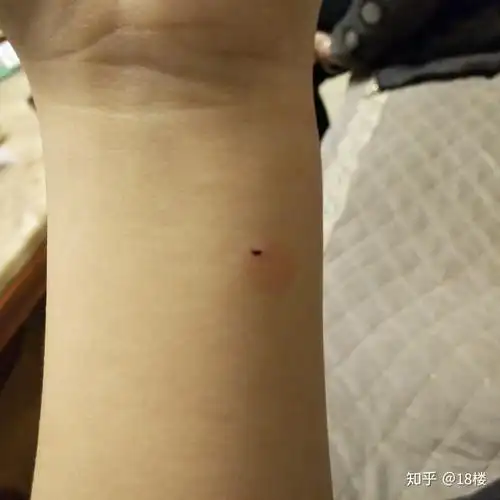 结核皮试出现如下状况,是啥结果呢?