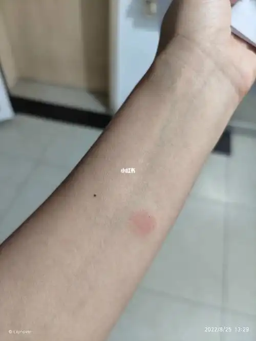 布病阴性,结核皮试阳性忐忑,不知道接下来怎么办啊