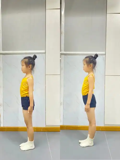 才知道原来小孩子也有骨盆前倾一说