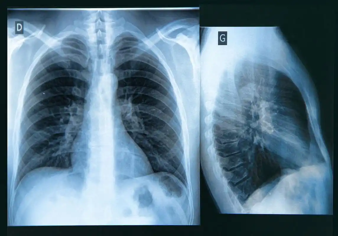 【拍了肺部ct,怎么判断是不是支气管炎?