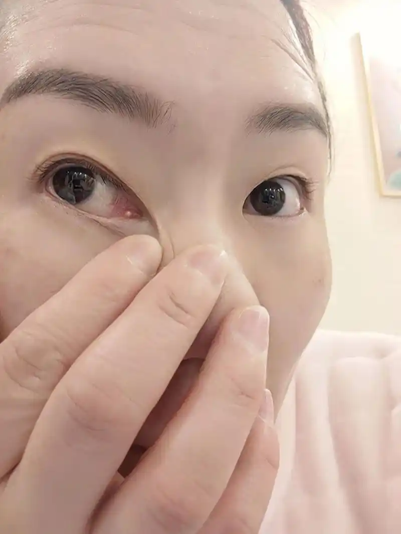 眼角长肉粒 眼角这里长了颗肉粒,不知道什么时候长的.