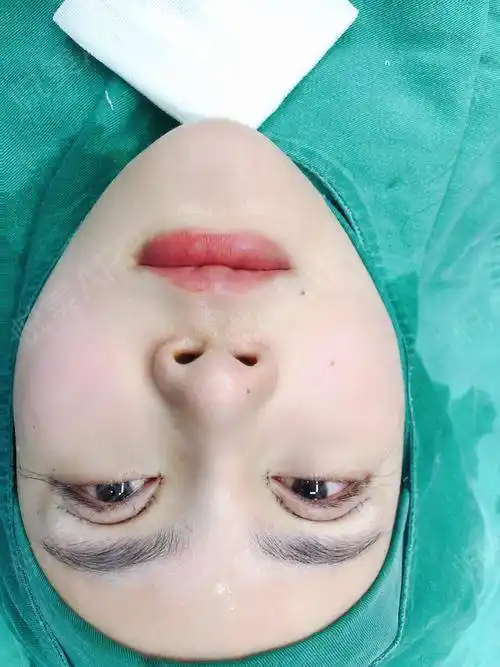 眼综合整形手术当天_眼型矫正手术当天_眼综合手术当天_开眼角手术