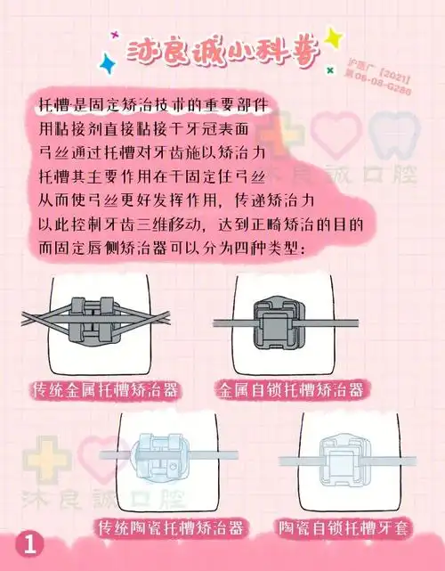粘接于牙冠表面077215 弓丝通过托槽对牙齿施以矫治力8715