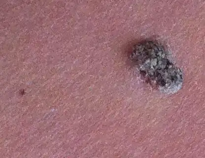 怀孕16周突然发现大腿后侧痣状突不知道是什么东西?