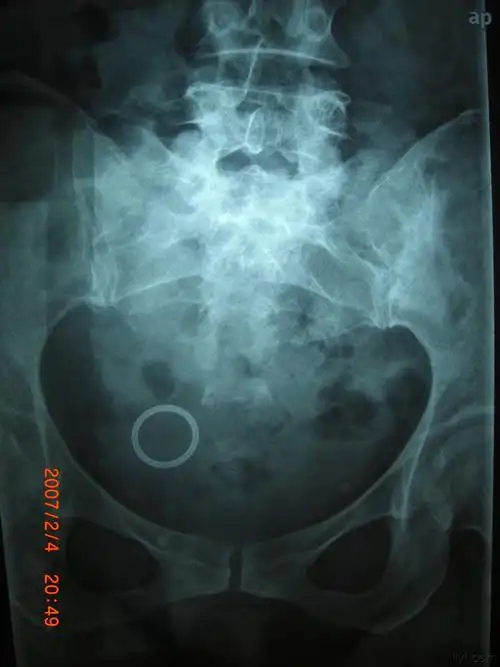 看图论病(尾椎骨折)