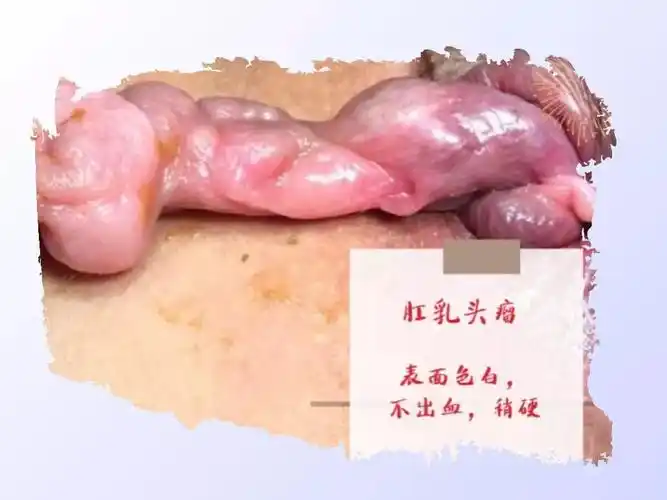 体检时被查出的"肛门息肉",最多可能就是它们 - 微医(挂号网)
