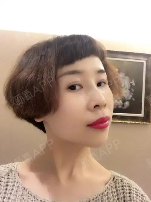 在肽慕医美线雕隆鼻第7天了,已经完全消肿,鼻子很_圈子-新氧美容整形