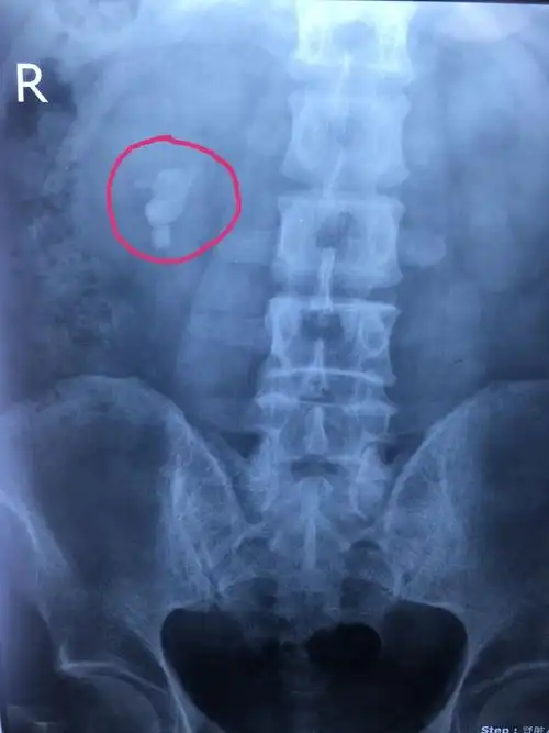 复杂性肾结石手术展示