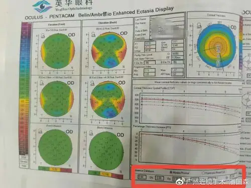 图3 典型圆锥角膜图2 潜在圆锥改变图1 正常地形图角膜地形图检查是