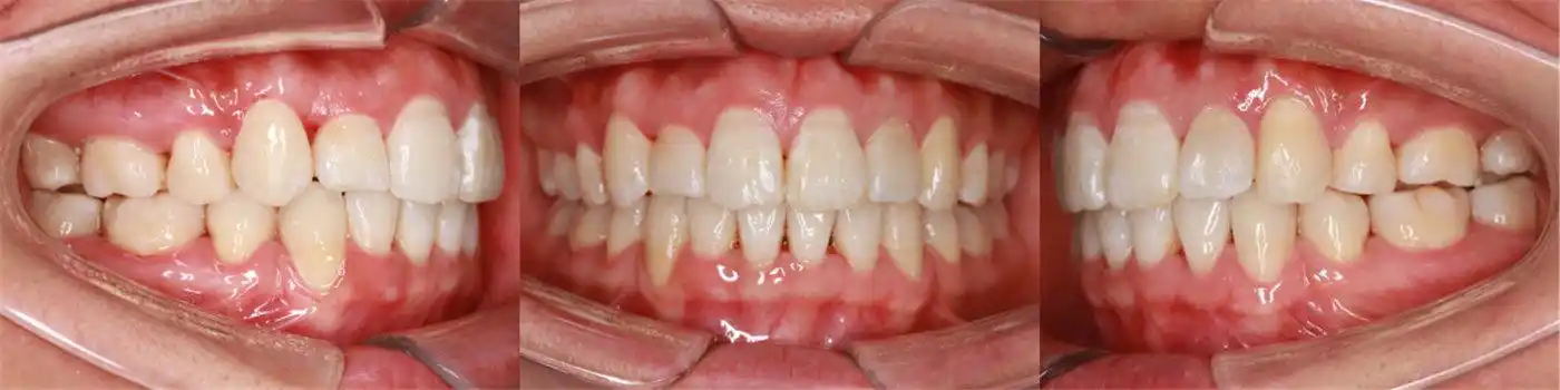 西安牙齿矫正张军主任正畸案例集:牙齿拥挤,前突的隐适美隐形矫正案例