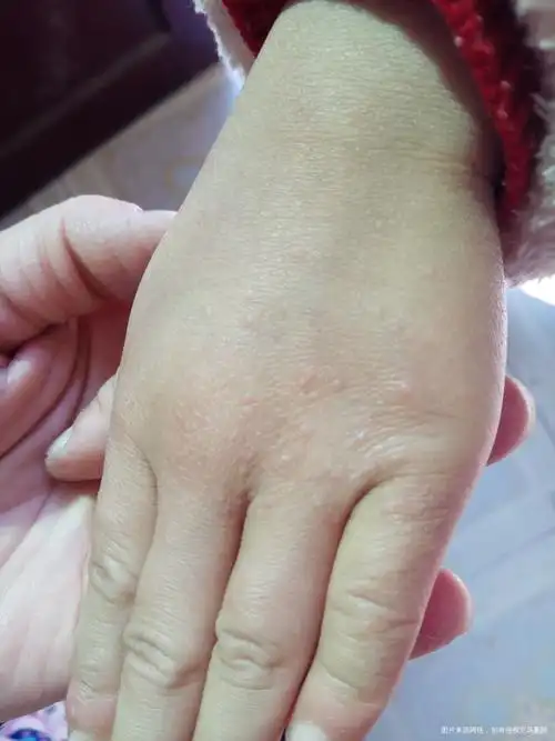 孩子手上长了些水泡是什么情况怎么才能好