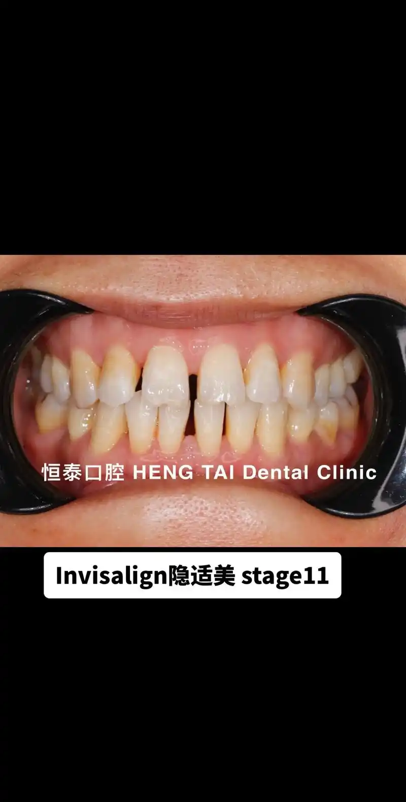 隐适美11周前后对比#牙医日常 #牙齿矫正 #隐适美 - 抖音