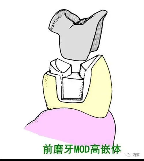 高嵌体的牙体预备步骤