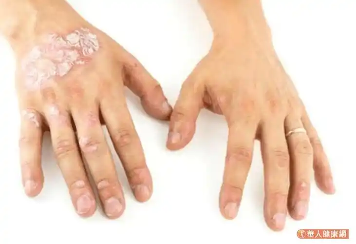 寻求药方月花数十万 女干癣恶化险命危