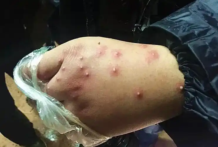 3岁孩子被红火蚁咬后,妈妈的"三个果断"救了娃,医生:有见识