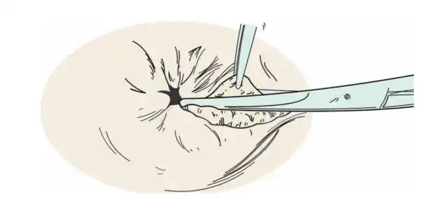混合痔保留齿线术金定国术式