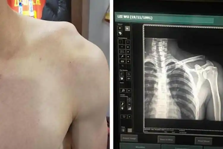 肩膀凸起骨头图解