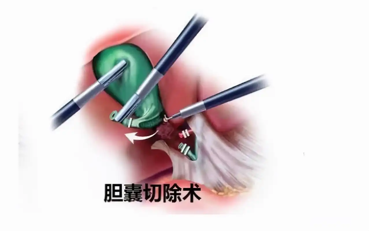 胆囊息肉一定会癌变吗?什么程度需要切除?