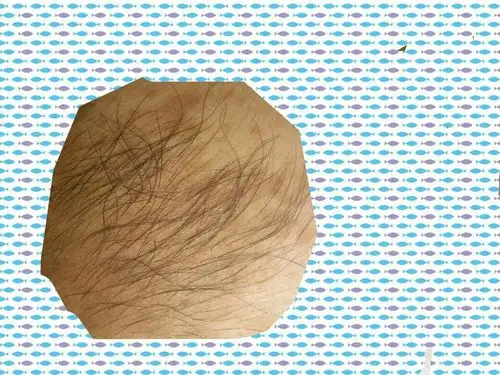 出生的胎记就长毛