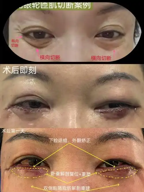 祛眼袋##眼袋修复##眼睛##眼整形##眼修复##双眼皮修复##双眼