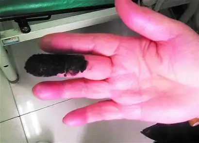 布袋藏蝎子老太被蜇伤(图)