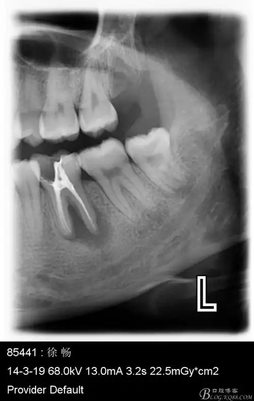 最近几例根尖阴影比较大的根尖周炎