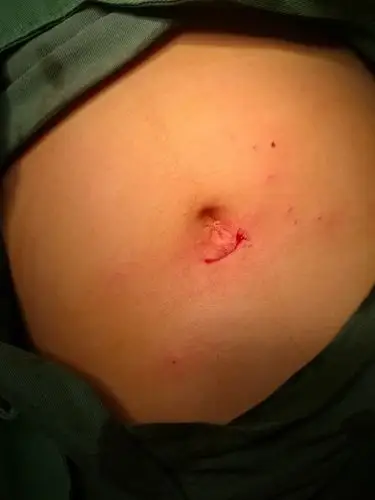 经脐单孔腹腔镜的高考