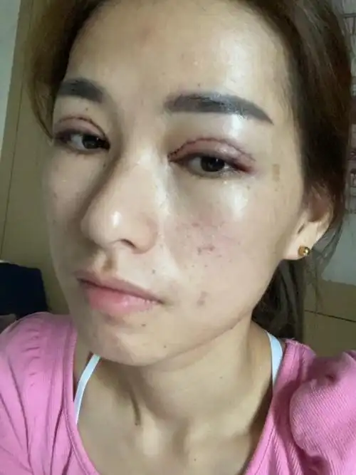 双眼皮术后一天肿胀的特别厉害,我不会是肿胀体质吧,_圈子-新氧美容