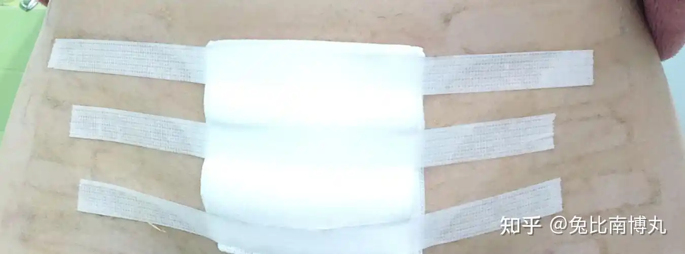 我的畸胎瘤手术记录开刀文末附刀口恢复过程图