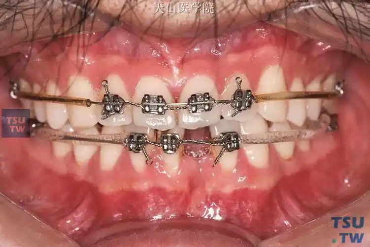 正畸弓丝欧米茄曲的弯制