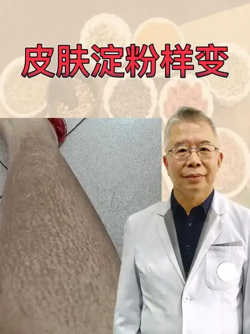 淀粉样变的朋友们在生活中的护理你要知道