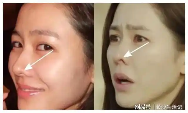 主要原因是   鼻翼缘退缩   ——随着年龄增长,软组织流失所导致的