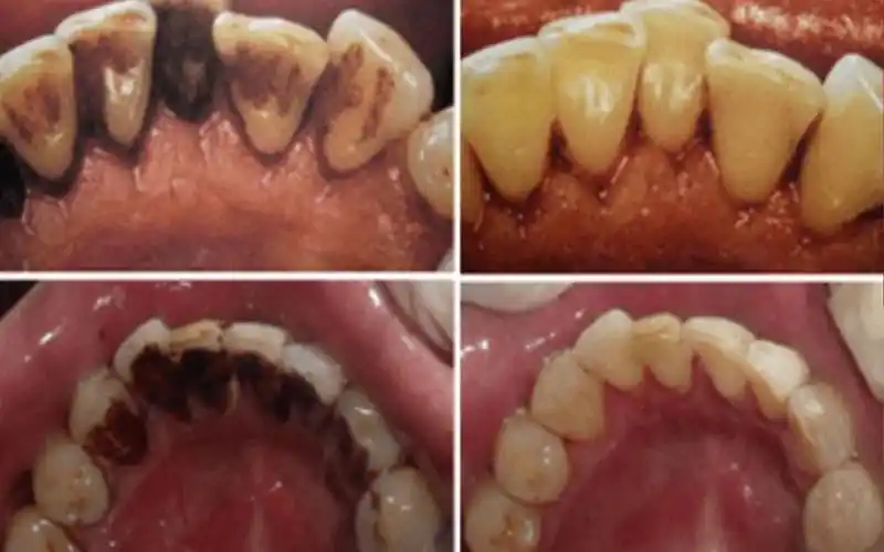 高效清洁牙菌斑,预防牙结石,有它就够了