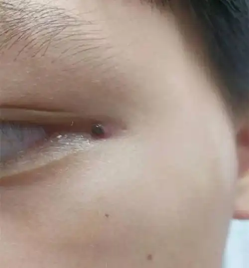 苏州一男孩被蜱虫叮咬,外出务必要当心!我们该如何预防?_手机搜狐网