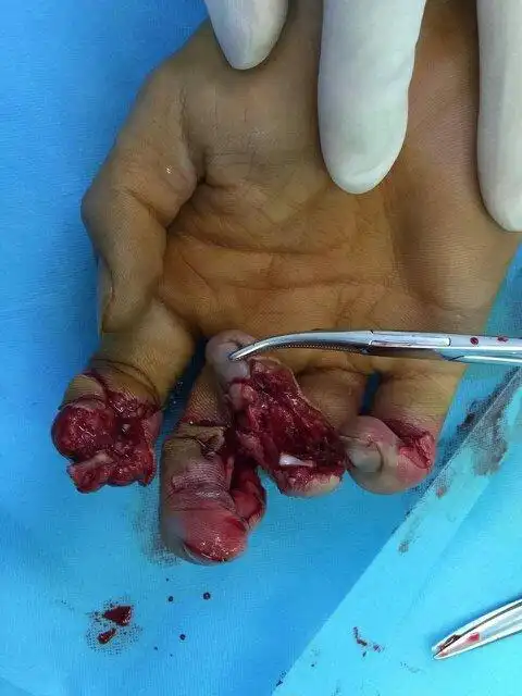 学校体育课,孩子三手指粉碎骨折,另外一个掉了一节,学校应负哪些责任