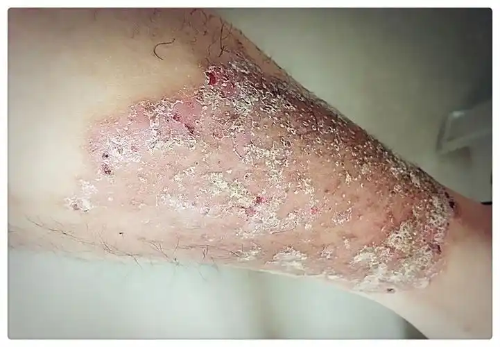 潞州中医世家 卢氏丽娟 名不虚传 . 手脚开裂 腿癣顽疾 药到肤新