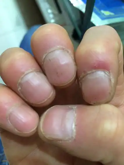 我的右手大拇指指甲凹凸不平 是什么原因