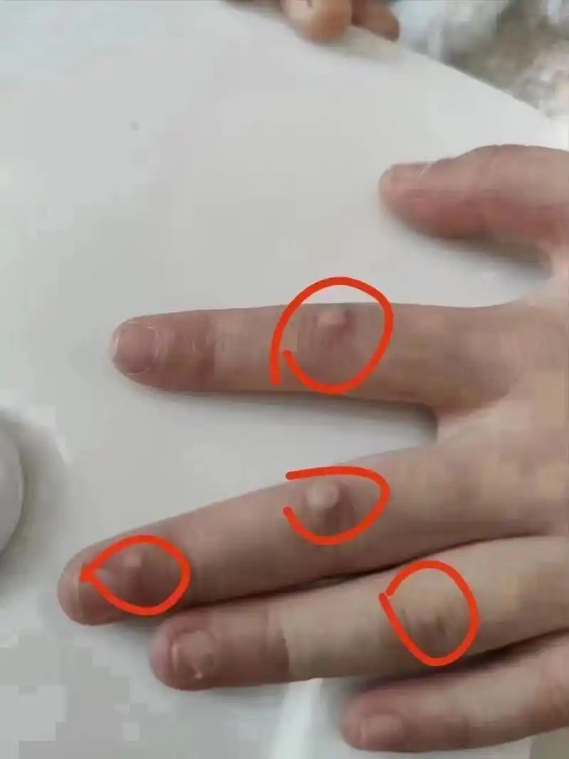 多发性寻常疣, !