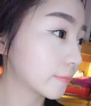 后来到了安徽韩美之后医生给我设计的是鼻综合,里面包括了:膨体隆鼻